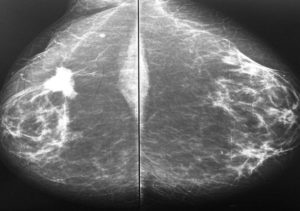 Lee más sobre el artículo El diagnóstico precoz del cáncer y la prevención pueden salvarte la vida